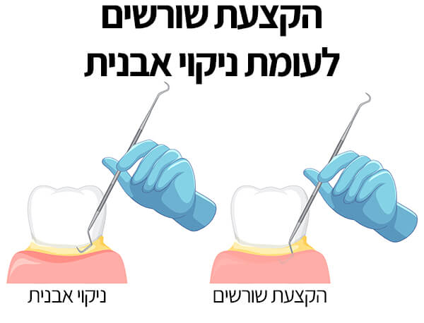 הקצעת שורשים לעומת ניקוי אבנית